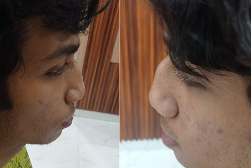Nose Treatment Done my Dr Sanjay Gupta